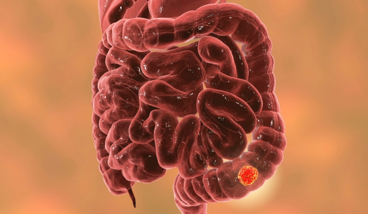 Colorectal Cancer Is No Longer Just a Disease of Older Adults