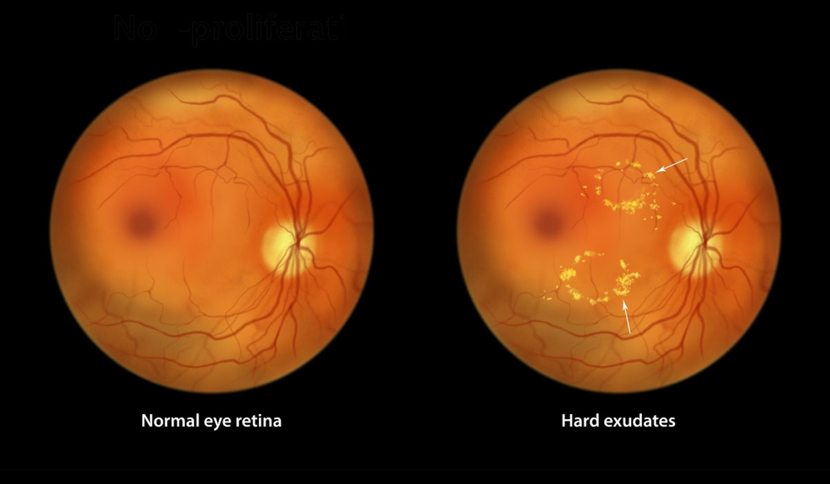 Eye X Ray Retinal Damage Diabetes