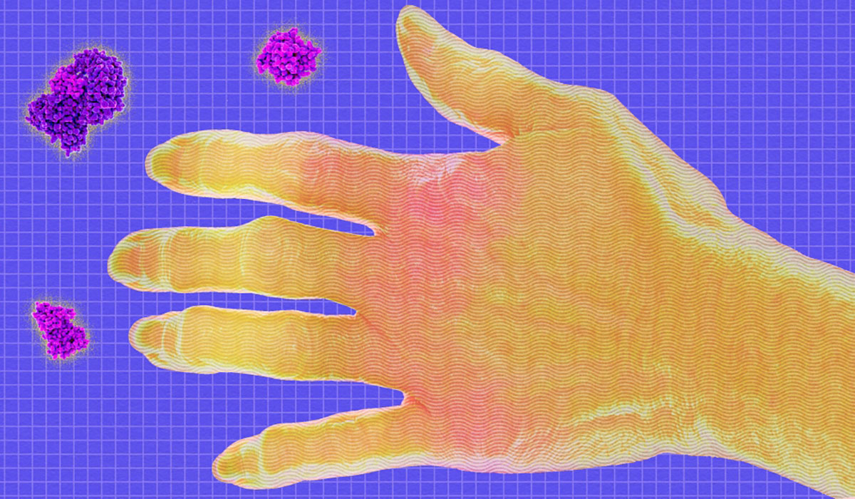 Hand Arthritis Scleroderma Grid Enzymes