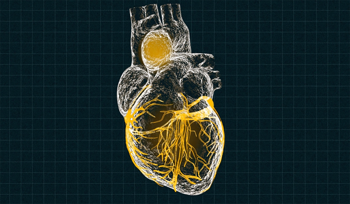 Human Heart Aortic Aneurysm Veins