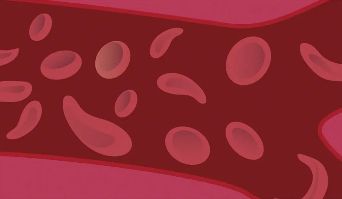 Michigan Med L Sickle Cell 01