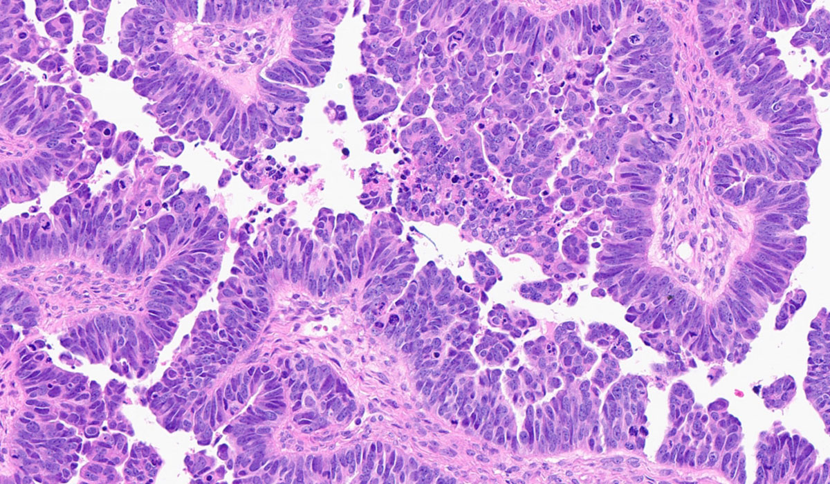 V2ovarian Cancer Cells