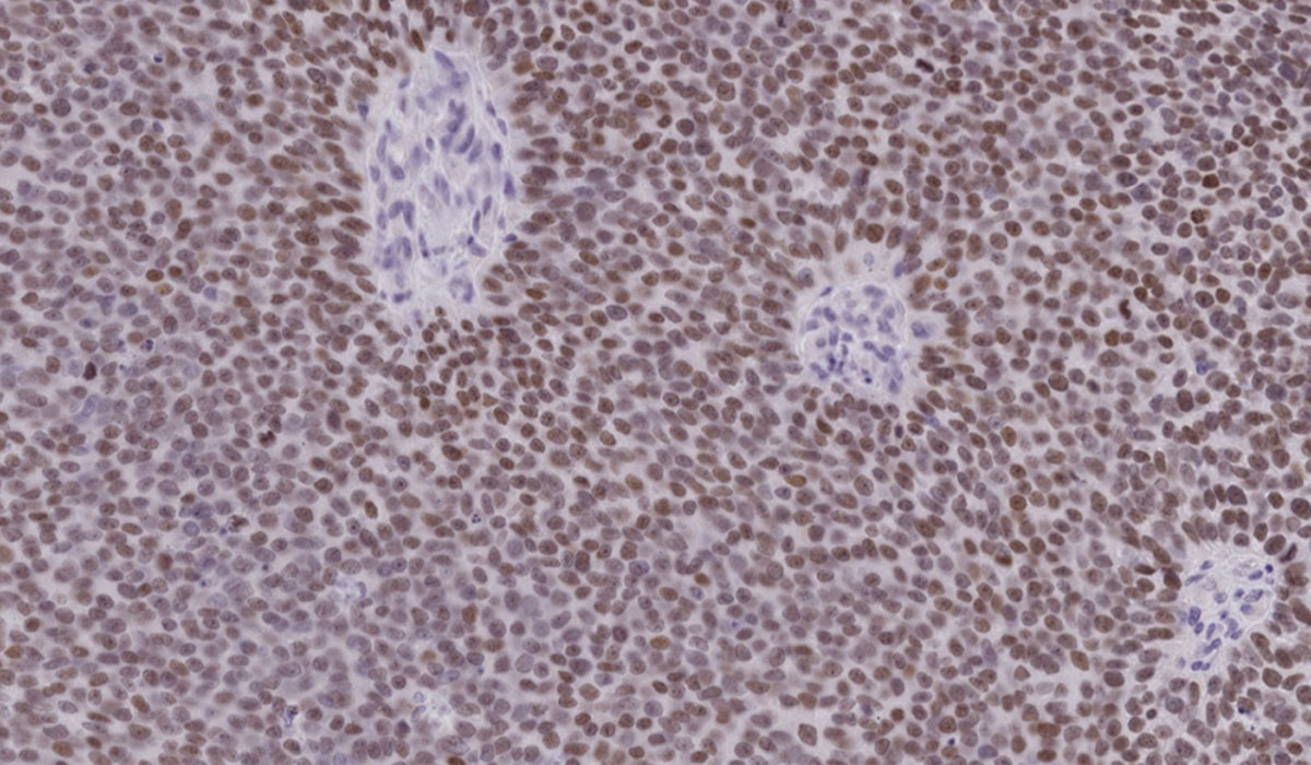 V2prostate Cancer Cells