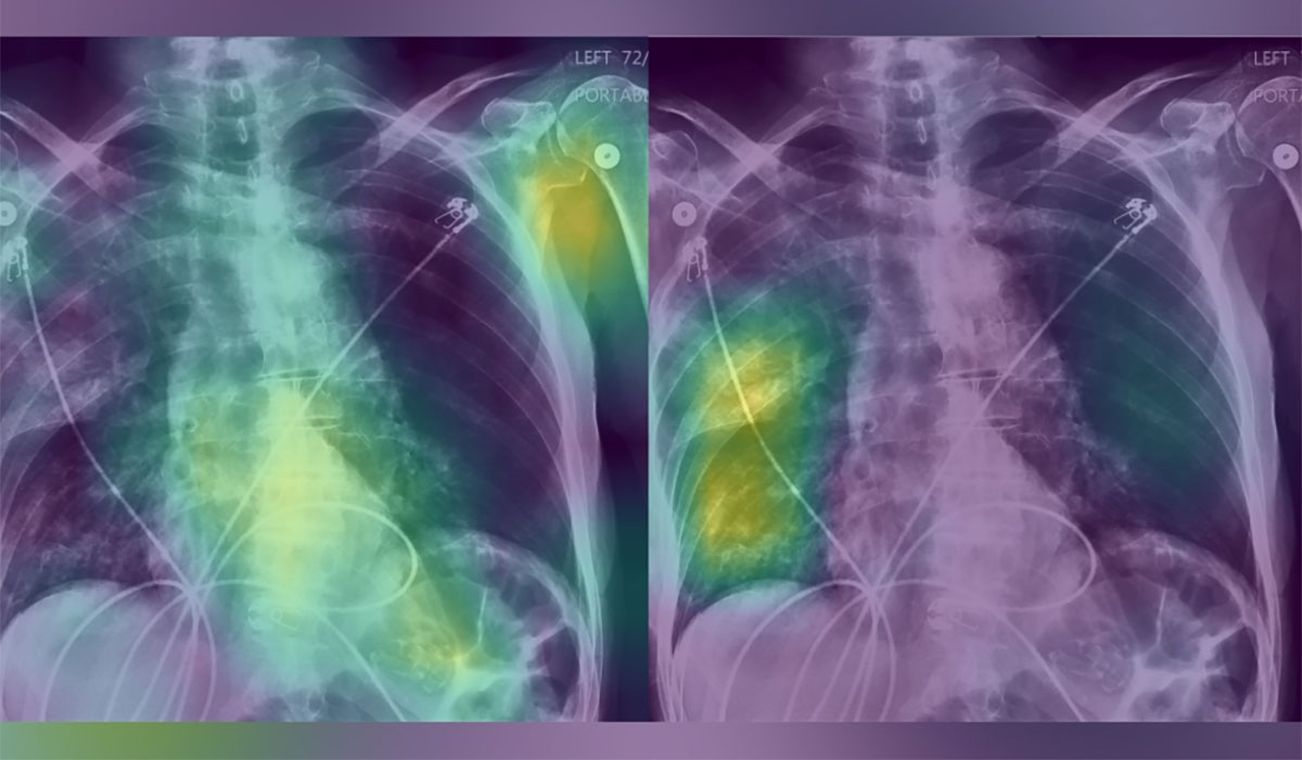 X Ray Rib Lung Purple (1)